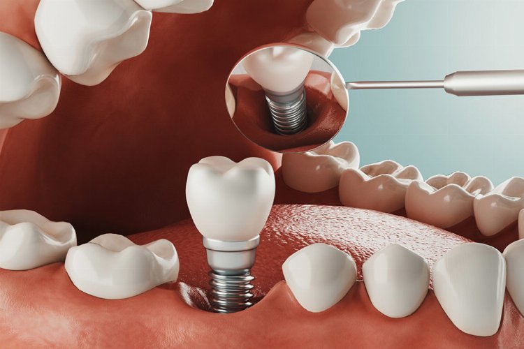 Diş tedavisinde implant zorlu bir süreç mi? -